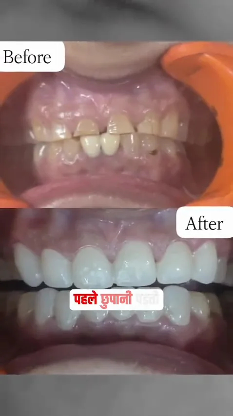 Smile makeover — before & after